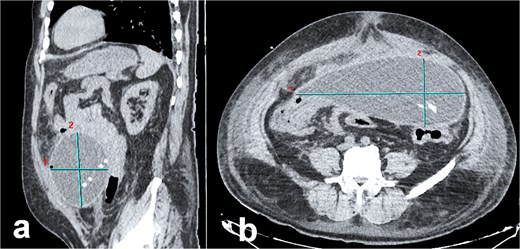 Abdominal CT imaging of peritoneal pseudocyst. (a) Sagittal view: The dialysis catheter tip (arrow) is visualized within the pseudocyst. Note collapsed small bowel loops displaced into the retroperitoneum. (b) Axial view: Encapsulated pseudocyst with thick, enhancing walls (asterisk), and homogeneous serous fluid content. Bowel loops are displaced posteriorly into the retroperitoneum.