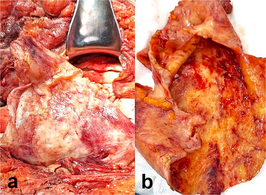 Intraoperative and gross pathological findings. (a) Intraoperative view: The pseudocyst exhibits smooth, hyperemic walls with dense adhesions to the parietal peritoneum (arrowheads) and scattered hemorrhagic foci. (b) Cross-sectional gross specimen: Fibrous capsule with thick, irregular walls (double arrow), and serous fluid within the lumen. Adherent fibrotic tissue is evident at the pseudocyst–peritoneum interface.