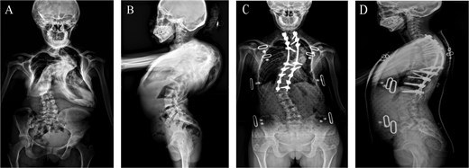 A patient with severe spinal deformity undergoes corrective spinal surgery. (A, B) Preoperative anteroposterior and lateral X-rays showing severe spinal deformity (cobb angle ≥60°). (C, D) Postoperative anteroposterior and lateral X-rays at 1 month showing stable internal fixation with satisfactory positioning.