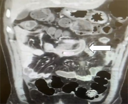 CT scan coronal view demonstrating the appendix with appendicolith at the mid-abdomen due to incomplete malrotation.