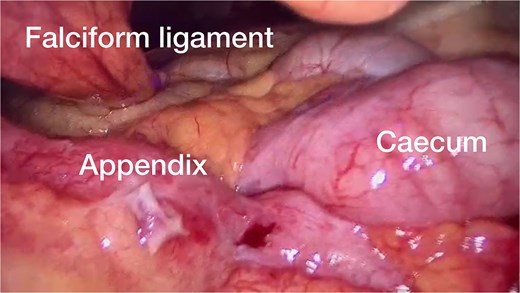 The intra-operative finding of the caecum, terminal ileum, and appendix was just below the falciform ligament.