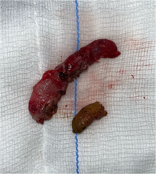 Inflamed appendix with appendicolith.