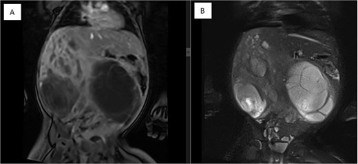 Coronal MRI images of the abdomen showing a mass effect in the right hepatic lobe. (A) Coronal T1 post-contrast and (B) coronal T2 HASTE FS images demonstrate spatial relationships, including compression of the right kidney, pancreas, and major vessels, with no invasion. The mass displaces bowel loops inferiorly and causes an anterior abdominal wall bulge.