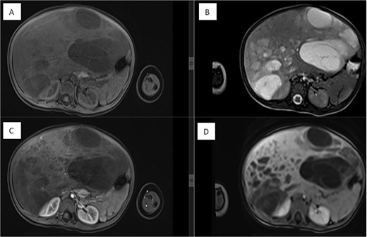 Dynamic MRI of the abdomen demonstrating a large, partially cystic, and solid lesion arising from the right hepatic lobe. (A) Axial T1 and (B) axial T2 images show the lesion’s mixed composition and internal structure. (C) Arterial and (D) portovenous phase post-contrast images reveal heterogeneous enhancement of the solid and septal components.