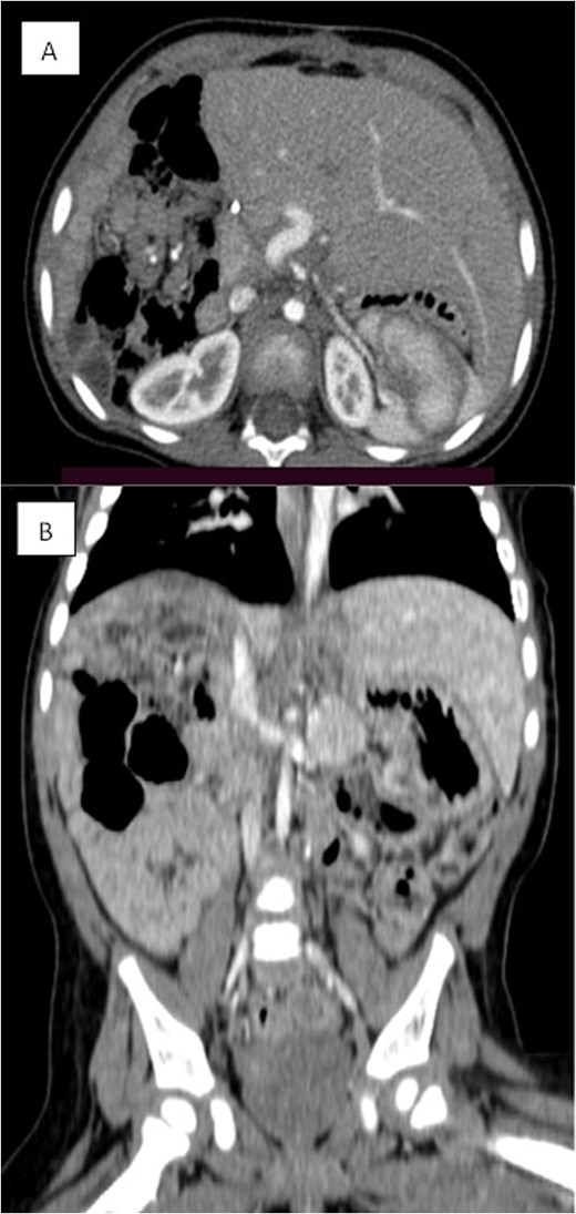 Triphasic CT examination of the abdomen post-right hepatectomy. (A) The axial view shows a clear operative bed with no residual enhancing lesions or collections. The (B) coronal view demonstrates compensatory hypertrophy and enlargement of the left hepatic lobe. Herniated bowel loops are visible, filling the right hypochondrial subphrenic region.