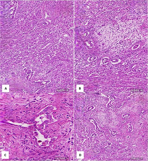 (A) Histological section showing interspersed islands of hepatocytes with retention of normal cell plate architecture (hematoxylin & eosin, 6.23×). (B) Myxoid area with benign duct structures and interspersed normal hepatocytes (hematoxylin & eosin, 6.98×). (C & D) Dilated and branching bile ducts show no cytological atypia (hematoxylin & eosin: C- 18.55×, D- 7.05×).