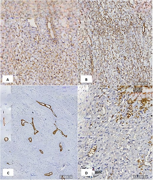 (A & B) Vimentin immunostain demonstrating positive cytoplasmic staining in neoplastic cells (6.26×). (C) CK7 immunostain highlights the benign bile duct epithelium (3.64×). (D) GLUT1 immunostain shows negative staining in neoplastic cells and positive staining in red blood cells (internal control) (11.44×).