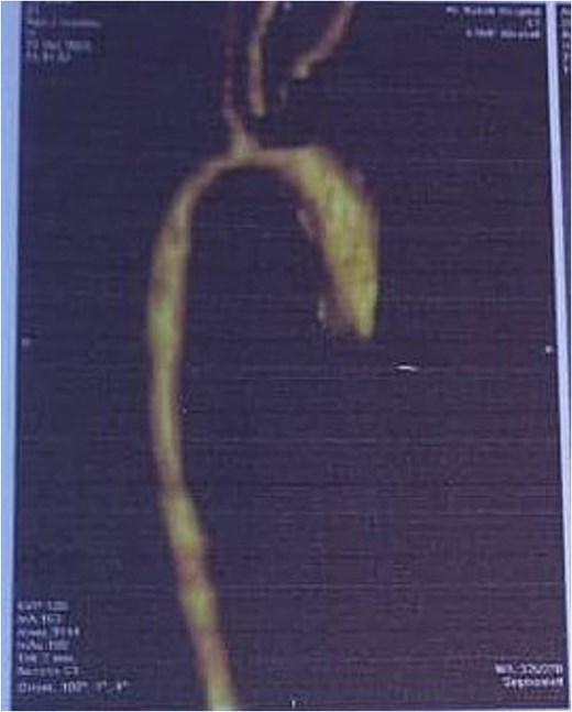 Preoperative CTA image showing the coarctation of the aorta.