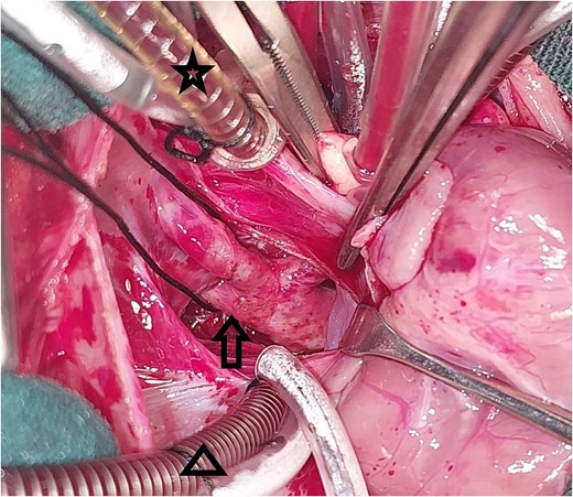 Intraoperative image showing the pulmonary venous confluence behind the heart: The star points to the venous cannula in the superior vena cava, the triangle points to the venous cannula in the inferior vena cava, the arrow points to the pulmonary venous confluence.