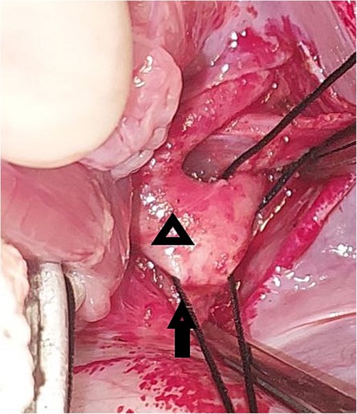 Intraoperative image showing the pulmonary venous confluence after lifting the heart out of the pericardium: The triangle points to the pulmonary venous confluence, and the arrow points to the vertical vein that crosses the diaphragm.