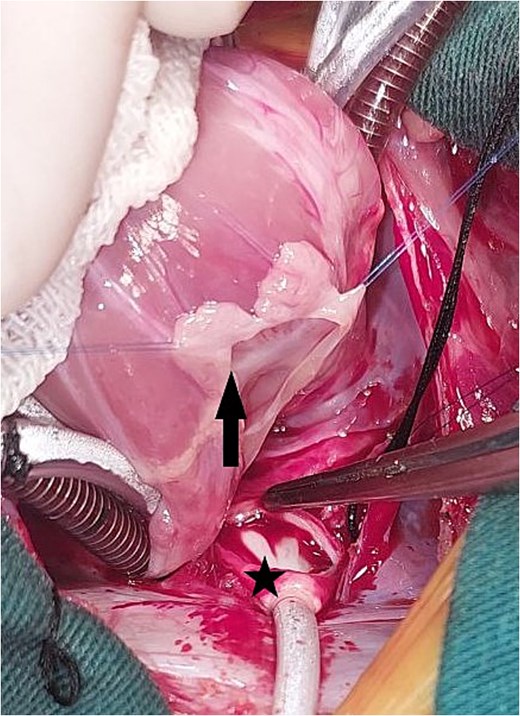 Intraoperative image showing the opened left atrium (the arrow), and the opened pulmonary confluence (the star).