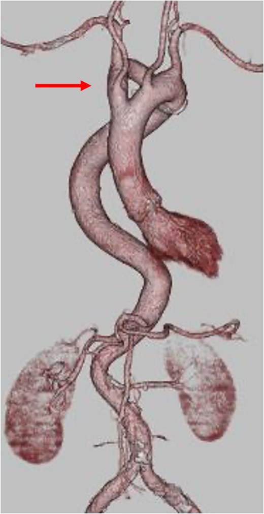 Three-dimensional CT reconstruction showing the double aortic arch (arrow) compressing the trachea.