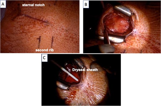 (A) A skin incision was made 5 cm from the sternal notch to the upper edge of the second rib. (B) The ascending aorta was exposed via J-shape partial sternotomy. (C) Evolut PRO PLUS 29 mm valve was inserted via the preinserted Dryseal sheath.