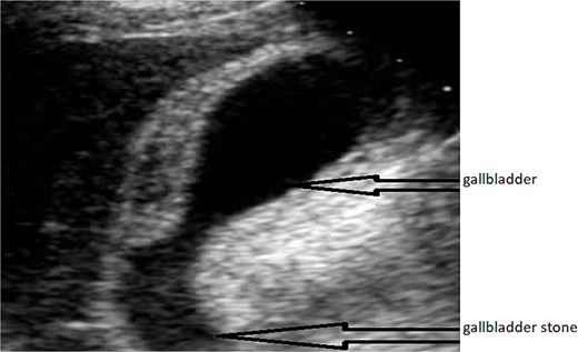 Ultrasound image showing the cholecystitis in our patient.