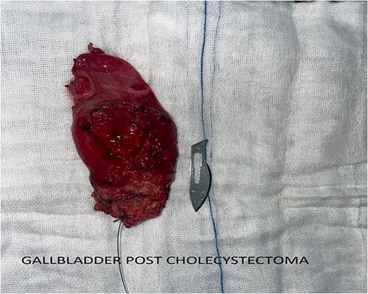 Image of the specimen after cholecystectomy.