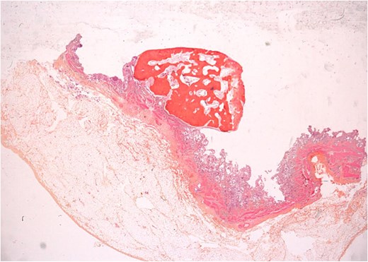 Microscopic image showing bone metaplasia in the gallbladder wall.