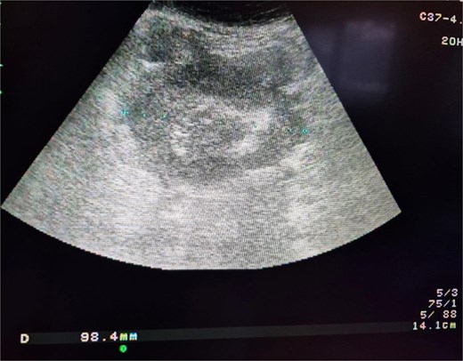 Ultrasound image of the small intestinal tumor.