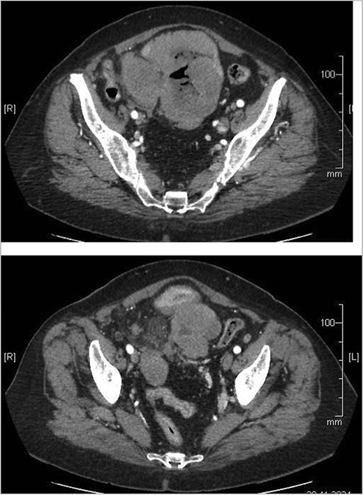 Abdominal CT showing small bowel tumor and similar to both ovaries.