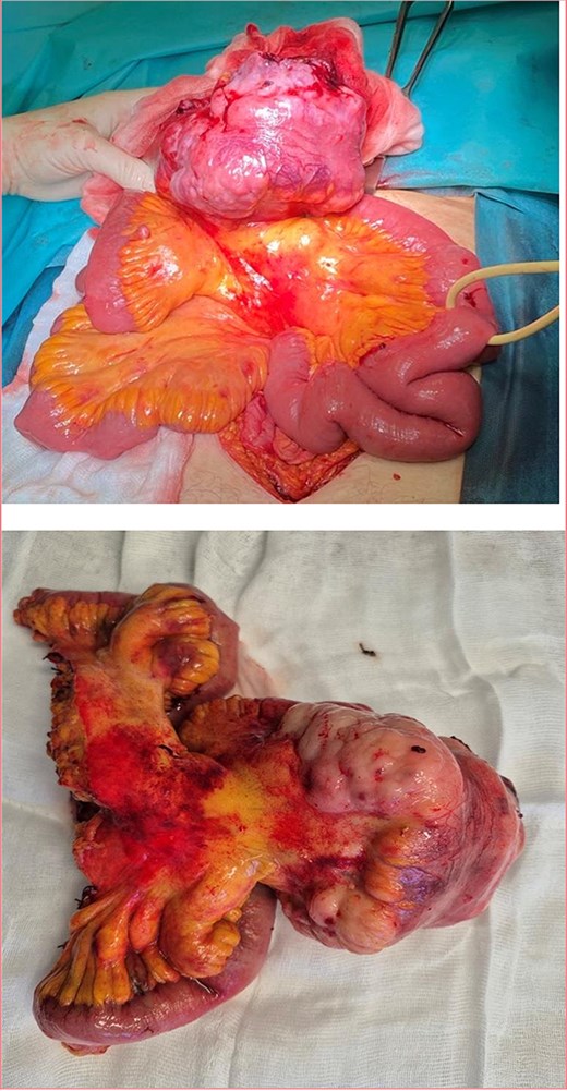 Ileal tumor obturating the intestine and visibly enlarged mesenteric lymph nodes.