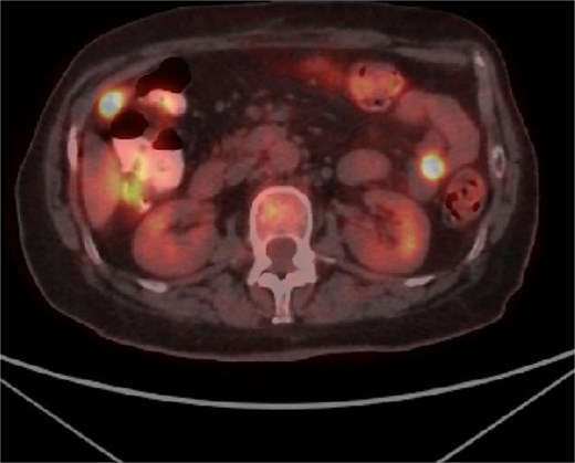 PET CT showing metabolic activity in abdominal and pelvic lymph nodes.