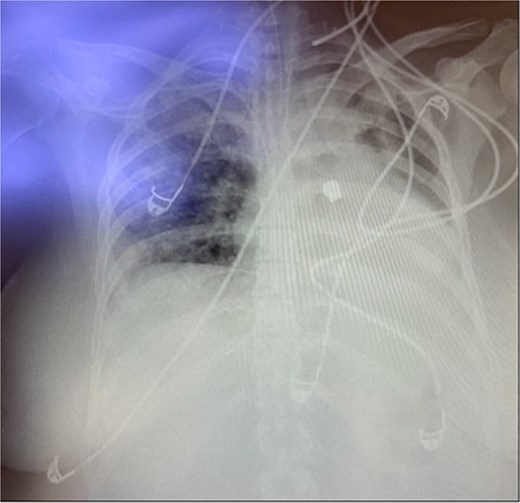 X-ray of the chest showing the foreign body in the left chest.