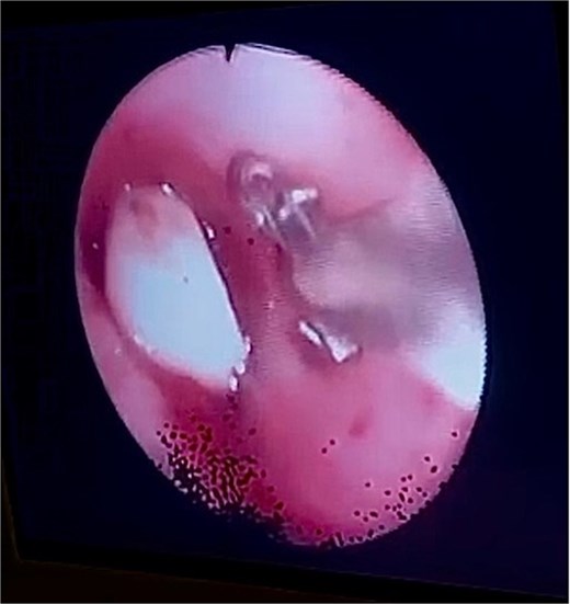 Bronchoscopy view showing the dental bridge lodged in the left mainstem bronchus.