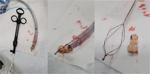 The dental bridge extracted by flexible bronchoscope.