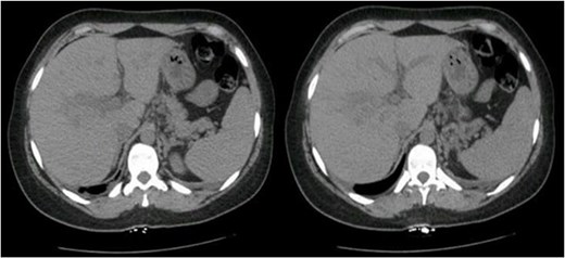 Abdominal and pelvic CT with IV contrast showed multiple scattered, ill-defined, and non-enhancing liver lesions, the largest measuring ~2.7 cm in segment VII.