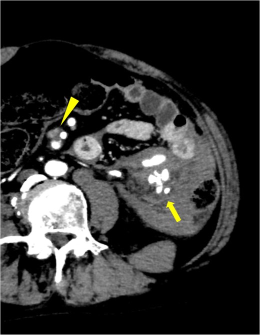 Extravasation continuous from IMA was observed (solid arrow), and active bleeding from the same region was suspected. Aneurysm with internal thrombus was observed near the origin of SMA (arrowhead).