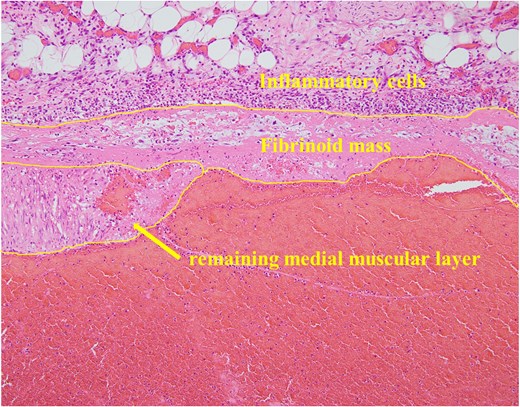 The vessel wall of the dilated artery was completely necrotic, and only a fibrin layer remained. In addition, an inflammatory cell infiltrate consisting primarily of neutrophils was observed around the affected blood vessel.