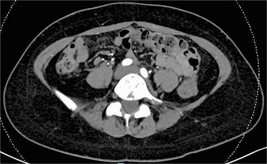 Preoperative CT angiography showing small maximum perforator diameter of 1 mm (arrow).