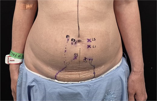 Preoperative markings of perforator locations.