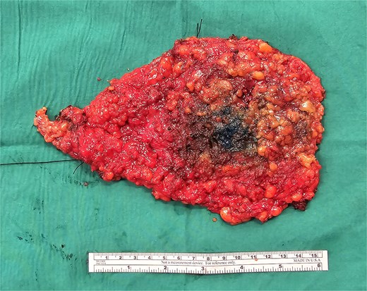 Right nipple sparing mastectomy specimen.