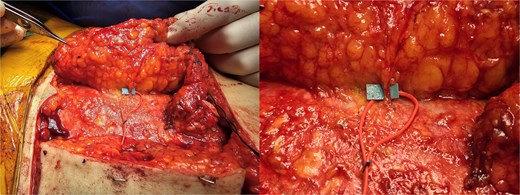 Largest perforator with diameter of 1 mm.