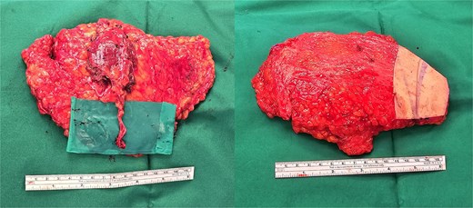 Right muscle-sparing TRAM flap.