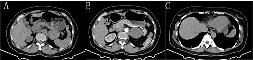 A: Gastric bronchogenic cyst on a plain CT scan (→), with a CT value of approximately 40.5 HU. B: The CT-enhanced arterial phase shows no enhancement of the cyst (→). C: A postoperative plain CT scan shows that the cyst has been successfully removed.