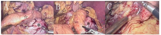 Cyst (*), pancreas (☆), lesser curvature of the stomach (△). A: The cyst originates from the lesser curvature of the stomach, located posterior to the pancreas. B: The cyst is adjacent to the lesser curvature of the stomach. C: The cyst after separation from the surrounding tissue (→ indicating the broken end).