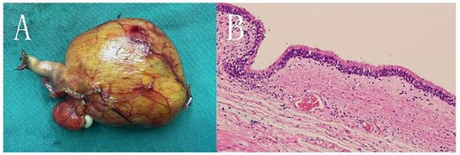 A: The cyst seen with the naked eye, displaying a clear boundary. B: HE staining under a light microscope (10 × 20 magnification) showing the cyst wall tissue, with ciliated columnar epithelium, foam cells, and lymphocytes visible.