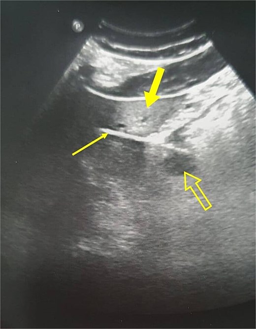 Abdominal ultrasound showing a linear structure (thin arrow) suggestive of a foreign body, with posterior acoustic artifact and regional edema in the liver (thick arrow). The stomach is marked with a not-filled arrow.