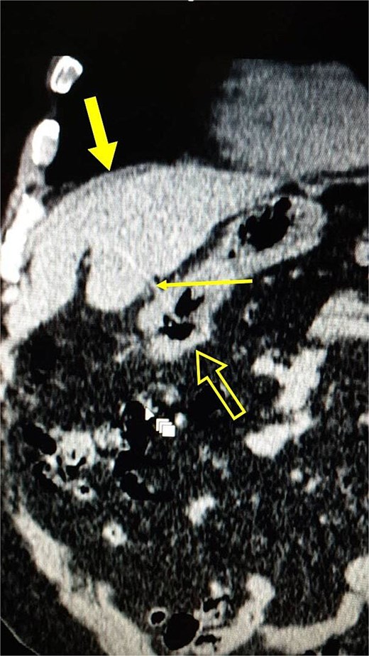 Coronal section of a non-contrast CT scan of the abdomen, showing a hyperdense linear structure (thin arrow) penetrating the stomach (not-filled arrow) and extending into the left liver lobe (thick arrow).