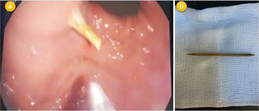 (a) Gastroscopic photograph showing the toothpick embedded in the stomach wall. (b) The extracted toothpick placed on a gauze after successful removal.
