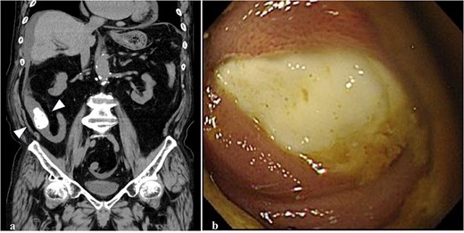 Abdominal CT and colonoscopy. (a) A highly dense mass with fine, low-density spots inside the lumen of the terminal ileum (arrowhead) on the colonal slice of plane CT. (b) The ileum lumen 20 cm proximal from the ileocecal valve was completely occupied by a whitish FB with a hard elasticity and smooth surface when visualized using a colonoscope.