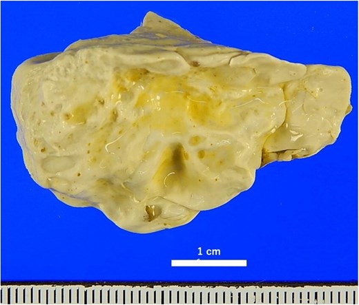 Macroscopic findings of the removed FB after formalin fixation the surface was yellowish-white and irregularly uneven, and the elasticity was similar to that of a plastic eraser.