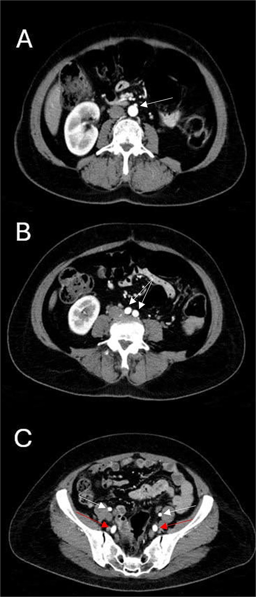 Axial CTA images show (A) the level of inferior mesenteric artery’s take-off from the abdominal aorta; (B) normal abdominal aortic bifurcation into common iliac arteries; and (C) bilateral prominent internal iliac arteries (lower arrows) and normal external iliac arteries (upper arrows).