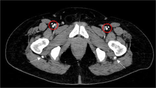 Axial CTA image shows normal femoral trifurcation (circles) and prominence of bilateral PSAs (arrows).