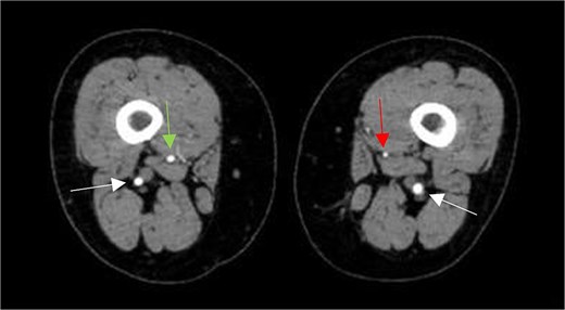 Axial CTA image shows hypoplastic left SFA along its course in the adductor canal (vertical arrow on left leg), but normal-sized right SFA (vertical arrow on right leg), and bilateral prominent PSAs (horizontal arrows).