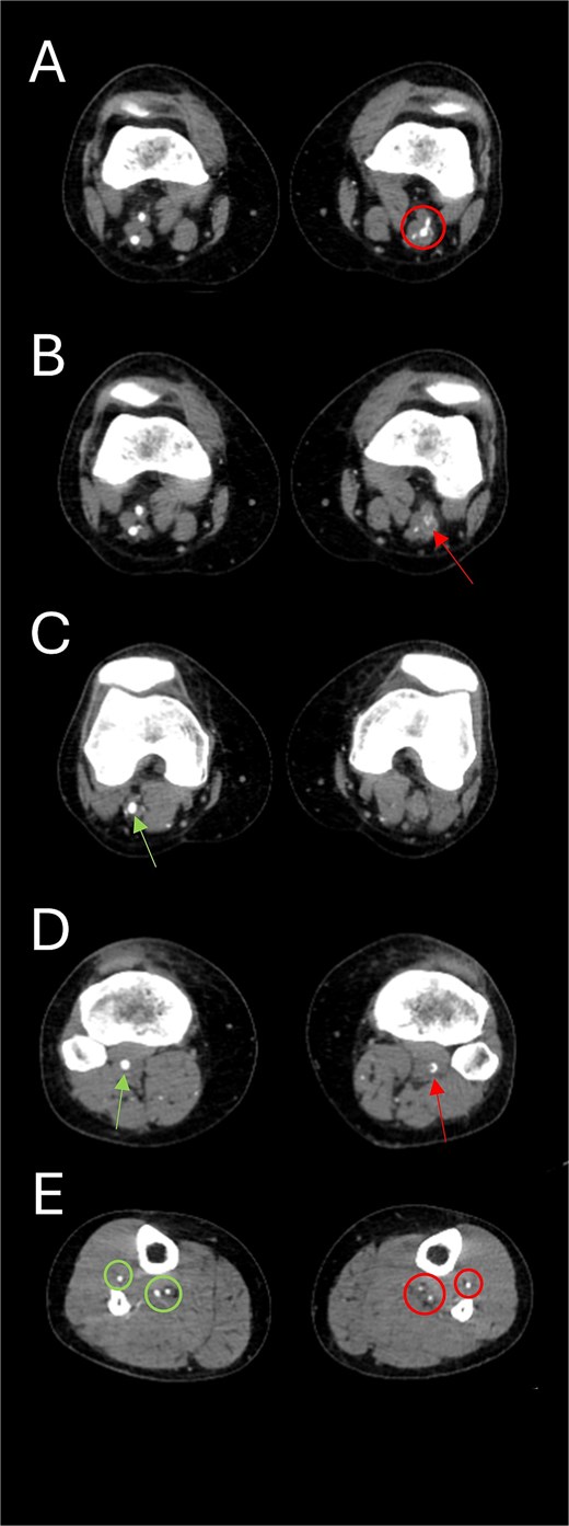 Axial CTA images show (A) the union of the left SFA and SFA; (B) occluded left popliteal artery; (C) the absence of the left popliteal artery and the emergence of the right popliteal artery from the union of right SFA and PSA; (D) the presence of a sub-occluded left popliteal artery (arrow on right leg) at the level of the fibular head and a normal right popliteal artery (arrow on left leg); and (E) the presence of hypoplastic left tibial and peroneal arteries (circles on left leg) along their course in the left leg compared to normal-sized arteries in the right leg (circles on right leg).