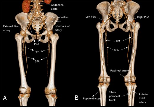 Three-dimensional reconstructed anatomic views anteriorly (A) show a narrowed left SFA, while the right SFA appears normal, both arising from the common femoral artery; and posteriorly (B) show the bilateral prominent PSAs as a continuation of the internal iliac arteries, the right SFA merges with the PSA as it supplies the dominant circulation of the right lower limb, the left PSA is occluded distally with no continuation into the popliteal artery; however, below the fibular head, a tibioperoneal trunk is present. Based on Ahn-min’s classification, this lower limb arterial pattern was consistent with type-I bilateral PSA.