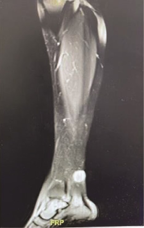 MRI demonstrating subcutaneous soft tissue mass on the posterior aspect of the lower left leg.