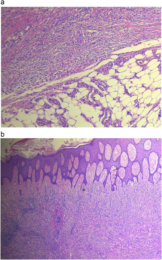 (a) Histopathology revealing cellular DF showing no infiltration, (b) DF showing dermal lesion.